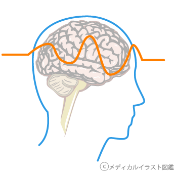 群発頭痛　守口市