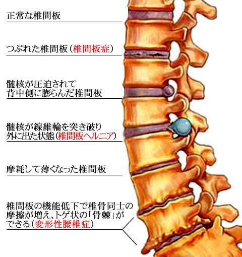 椎間板ヘルニア　高槻市
