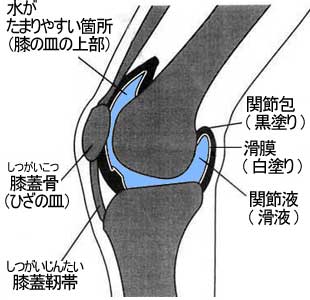 膝 ひざ を打撲して水がたまりぶよぶよの大阪市北区の方