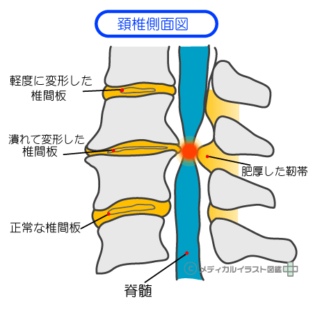 頚椎ヘルニア